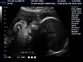 AMT30weeks-2.jpg